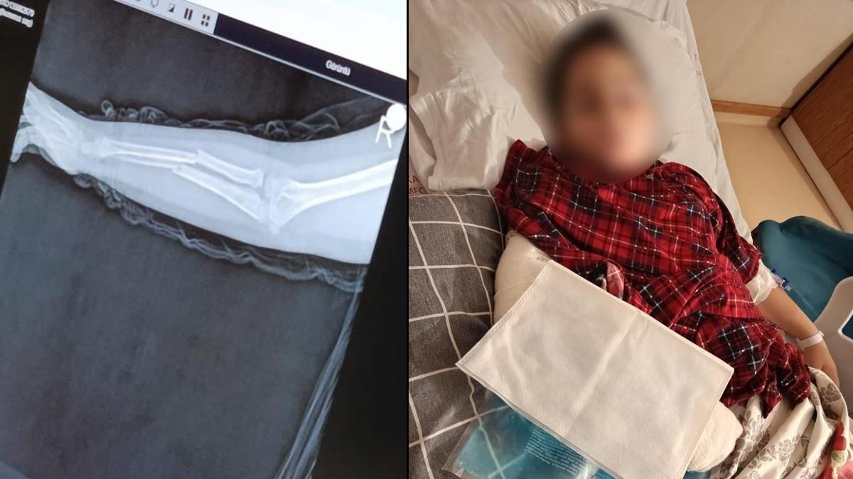 Okulda akran zorbalığı. 9 yaşındaki çocuk arkadaşının kolunu kırdı